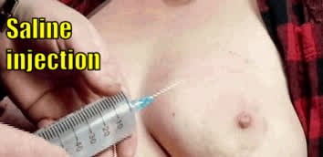 Saline injection into my tit. This is a whole different level of excruciating pain