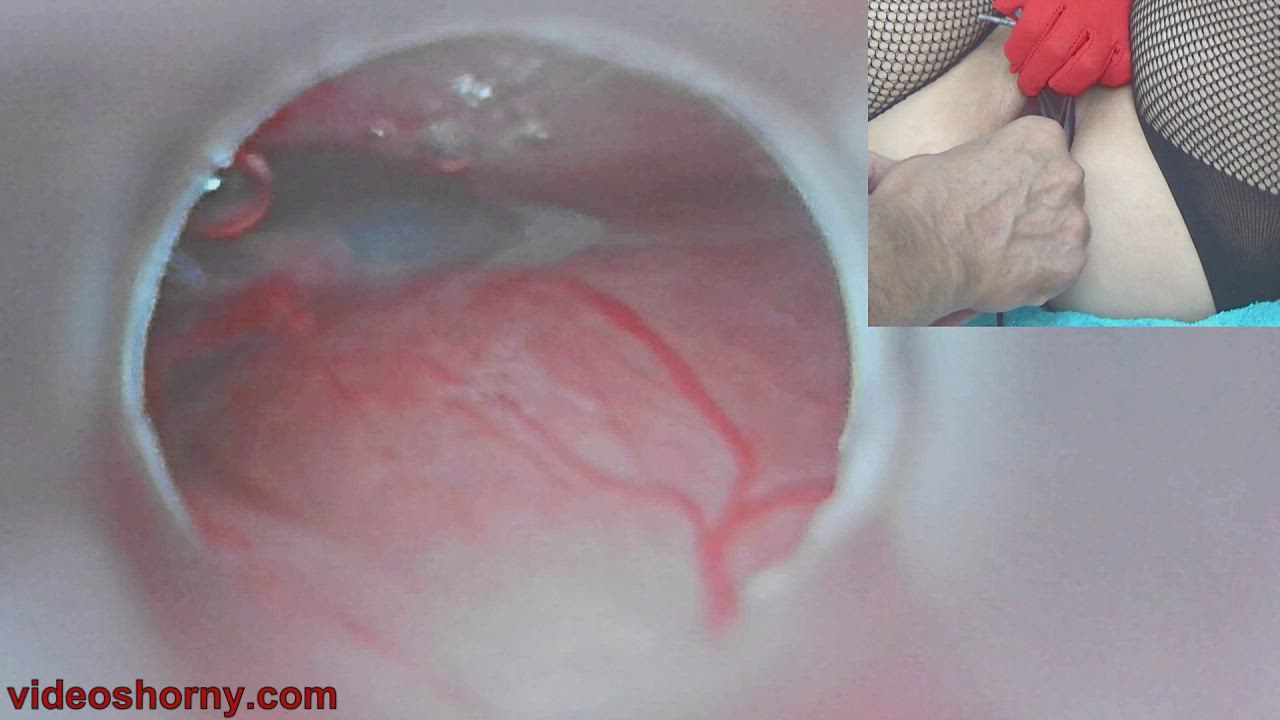 Impregnation with Cum in Cervix and Endoscope Camera in Uterus