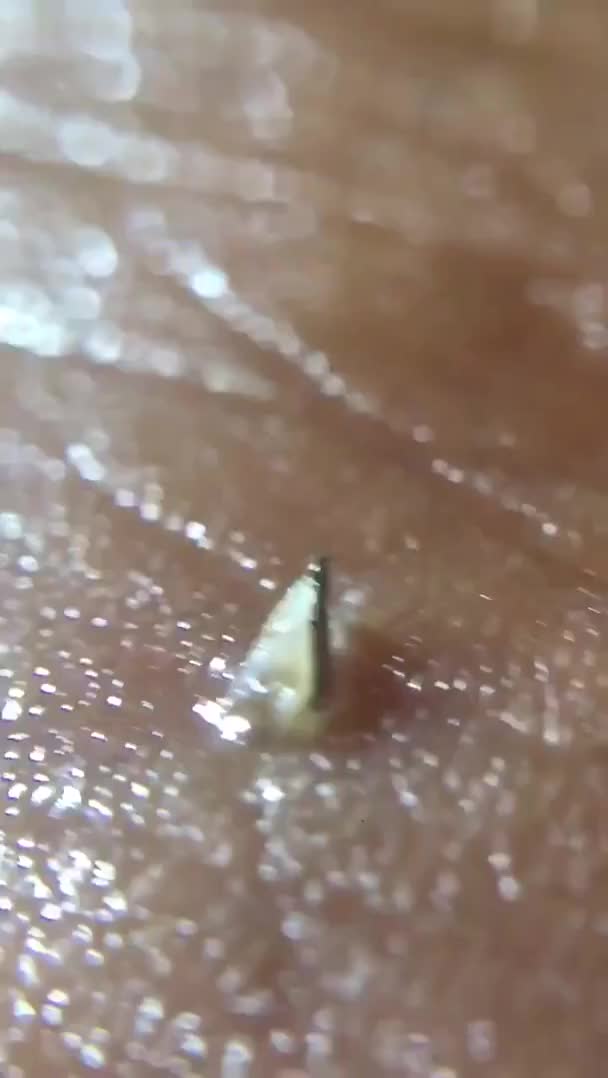 Try to remove small splinter on the feet