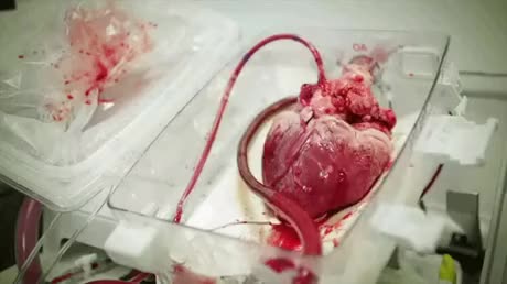 Heart in a box - This system is used to keep organs safe during transport for transplantation