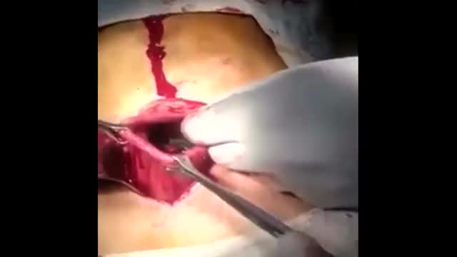 Doctors Remove 18 Toothbrushes From Man's Stomach