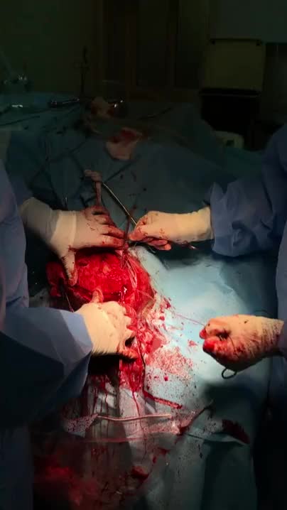 Cutting the skull with a Gigli Saw during emergency subdural hematoma removal.