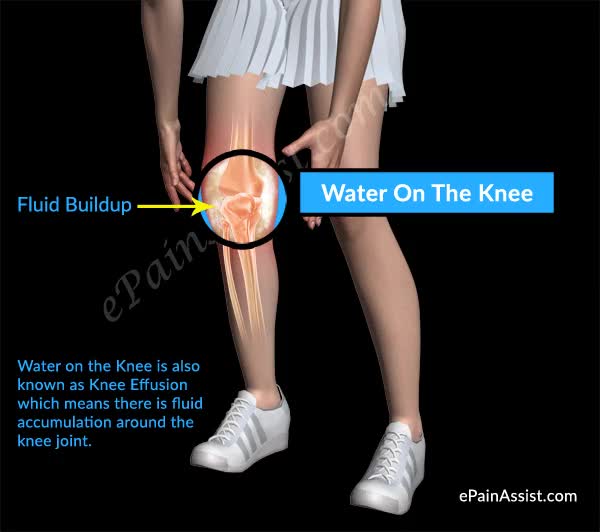 Water On The Knee or Knee Effusion - ePainAssist.com