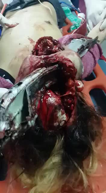 Man's Head is Impaled by Metal (NSFL)
