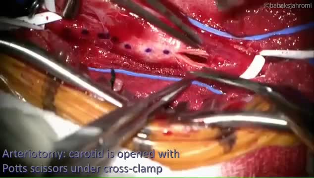 carotid-plaque